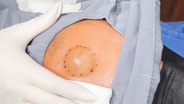Lipoma Surprise - Dr. Pimple Popper: This Is Zit - TLC GO
