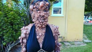Covered in Thousands of Tumors